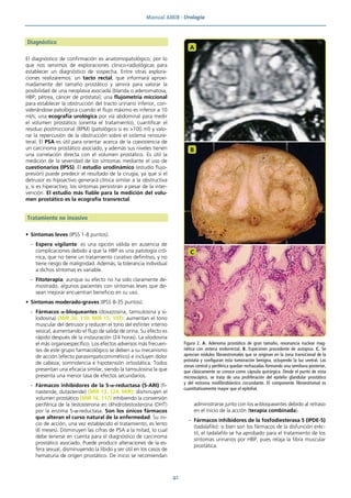 Manual AMIR · Urología
42
Diagnóstico
El diagnóstico de confirmación es anatomopatológico; por lo
que nos servimos de exploraciones clinico-radiológicas para
establecer un diagnóstico de sospecha. Entre otras explora-
ciones realizaremos: un tacto rectal, que informará aproxi-
madamente del tamaño prostático y servirá para valorar la
posibilidad de una neoplasia asociada (blanda o adenomatosa,
HBP; pétrea, cáncer de próstata); una flujometría miccional
para establecer la obstrucción del tracto urinario inferior, con-
siderándose patológica cuando el flujo máximo es inferior a 10
ml/s; una ecografía urológica por vía abdominal para medir
el volumen prostático (orienta el tratamiento), cuantificar el
residuo postmiccional (RPM) (patológico si es >100 ml) y valo-
rar la repercusión de la obstrucción sobre el sistema renoure-
teral. El PSA es útil para orientar acerca de la coexistencia de
un carcinoma prostático asociado, y además sus niveles tienen
una correlación directa con el volumen prostático. Es útil la
medición de la severidad de los síntomas mediante el uso de
cuestionarios (IPSS). El estudio urodinámico (estudio flujo-
presión) puede predecir el resultado de la cirugía, ya que si el
detrusor es hipoactivo generará clínica similar a la obstructiva
y, si es hiperactivo, los síntomas persistirán a pesar de la inter-
vención. El estudio más fiable para la medición del volu-
men prostático es la ecografía transrectal.
Tratamiento no invasivo
• Síntomas leves (IPSS 1-8 puntos).
- Espera vigilante: es una opción válida en ausencia de
complicaciones debido a que la HBP es una patología cró-
nica, que no tiene un tratamiento curativo definitivo, y no
tiene riesgo de malignidad. Además, la tolerancia individual
a dichos síntomas es variable.
- Fitoterapia: aunque su efecto no ha sido claramente de-
mostrado, algunos pacientes con síntomas leves que de-
sean mejorar encuentran beneficio en su uso.
• Síntomas moderado-graves (IPSS 8-35 puntos).
- Fármacos α-bloqueantes (doxazosina, tamsulosina y si-
lodosina) (MIR 20, 110; MIR 15, 107): aumentan el tono
muscular del detrusor y reducen el tono del esfínter interno
vesical, aumentando el flujo de salida de orina. Su efecto es
rápido después de la instauración (24 horas). La silodosina
el más organoespecífico. Los efectos adversos más frecuen-
tes de este grupo farmacológico se deben a su mecanismo
de acción (efecto parasimpaticomimético) e incluyen dolor
de cabeza, somnolencia e hipotensión ortostática. Todos
presentan una eficacia similar, siendo la tamsulosina la que
presenta una menor tasa de efectos secundarios.
- Fármacos inhibidores de la 5-α-reductasa (5-ARI) (fi-
nasteride, dutasteride) (MIR 13, 124; MIR): disminuyen el
volumen prostático (MIR 16, 117) inhibiendo la conversión
periférica de la testosterona en dihidrotestosterona (DHT)
por la enzima 5-α-reductasa. Son los únicos fármacos
que alteran el curso natural de la enfermedad. Su ini-
cio de acción, una vez establecido el tratamiento, es lento
(6 meses). Disminuyen las cifras de PSA a la mitad, lo cual
debe tenerse en cuenta para el diagnóstico de carcinoma
prostático asociado. Puede producir alteraciones de la es-
fera sexual, disminuyendo la libido y ser útil en los casos de
hematuria de origen prostático. De inicio se recomiendan
administrarse junto con los α-bloqueantes debido al retraso
en el inicio de la acción (terapia combinada).
- Fármacos inhibidores de la fosfodiesterasa 5 (IPDE-5)
(tadalafilo): si bien son los fármacos de la disfunción eréc-
til, el tadalafilo se ha aprobado para el tratamiento de los
síntomas urinarios por HBP, pues relaja la fibra muscular
prostática.
Figura 2. A. Adenoma prostático de gran tamaño, resonancia nuclear mag-
nética con antena endorrectal. B. Especimen procedente de autopsia. C. Se
aprecian nódulos fibroestromales que se originan en la zona transicional de la
próstata y configuran esta tumoración benigna, ocluyendo la luz uretral. Las
zonas central y periférica quedan rechazadas formando una semiluna posterior,
que clásicamente se conoce como cápsula quirúrgica. Desde el punto de vista
microscópico, se trata de una proliferación del epitelio glandular prostático
y del estroma miofibroblástico circundante. El componente fibroestromal es
cuantitativamente mayor que el epitelial.
A
B
C
 