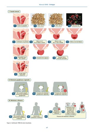 Manual AMIR · Urología
46
Figura 2. Clasificación TNM del cáncer de próstata.
M. Metástasis a distancia
T. Tamaño tumoral
N. Metástasis ganglionares regionales
Tumor no palpable
T1
Confinado a la próstata Afecta a los dos lóbulos
T2 T2a T2b T2c
Afecta a la ½
de un lóbulo o menos
Afecta a más
de la ½ de un lóbulo
Invasión de la cápsula
T3a T3b
T3
Extendido fuera
de la cápsula
Invasión de las
vesículas seminales
T4
Invade tejido
subyacente
No se puede asegurar
presencia de metástasis
ganglionares
Nx N1
N0
Ausencia de metástasis
ganglionares regionales
T1a RTU <5% T1b T1c
RTU >5% Elevación PSA
? Presencia de metástasis
ganglionares regionales
Mx
No se puede asegurar
presencia de metástasis
a distancia
? M0
Ausencia de
metástasis a distancia
M1 Presencia de metástasis a distancia
M1a
Metástasis
ganglionares
a distancia
Metástasis óseas
Los huesos más
afectados son:
pelvis y sacro,
columna, fémur,
costillas y escápula
M1b M1c Otras
 