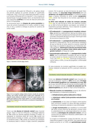 Manual AMIR · Urología
52
La combinación del grado de infiltración y de aplasia celular
nos permite clasificar los tumores vesicales en superficiales
(riesgo alto: TaG3, T1G3 y CIS; riesgo bajo-intermedio: el resto)
y en tumores infiltrantes (≥T2). En caso de T1, G3 y muestra sin
representación muscular (excepto TaG1), se recomienda hacer
una nueva RTUv (re-RTUv) en el sitio de resección previo para
evitar el infraestadiaje.
Se recomienda hacer una biopsia de uretra prostática en
casos de tumores localizados en el cuello, cuando se sospe-
cha un CIS y cuando la citología es positiva en ausencia de
tumor visible.
Carcinoma vesical no músculo invasivo (“superficial”)
Tumor que no alcanza el músculo vesical (capa muscular
propia). Según el nivel de infiltración y morfología hablamos
de: Ta cuando son lesiones papilares limitadas al urotelio, sin
sobrepasar la membrana basal del mismo; Cis cuando son
lesiones planas limitadas al urotelio, que tampoco sobrepasan
la membrana basal; o T1 cuando son lesiones que atraviesan
la membrana basal e infiltran el tejido conectivo subepitelial
(corion). Por lo general, se trata de lesiones de grado histo-
lógico variable, con muy bajo riesgo metastásico pero con
tendencia a la recidiva (recurrencia). En ocasiones pueden
llegar a hacerse infiltrantes en dicha recidiva (progresión)
(MIR), siendo más frecuente en los tumores superficiales de
alto riesgo.
La RTUv está indicada en todos los tumores vesicales
(MIR) que, en caso de que el tumor sea superficial constitu-
ye no sólo la forma de obtener una biopsia, sino también el
tratamiento quirúrgico definitivo. Tras la resección se pueden
realizar instilaciones endovesicales:
• QT endovesical en el postoperatorio inmediato (mitomi-
cina, epirubicina y doxorubicina): destruye las células tumo-
rales en suspensión y produce quimiorresección de las células
tumorales remanentes del lecho quirúrgico. Disminuye la tasa
de recurrencia hasta en el 10%
• QT endovesical en el postoperatorio tardío (mitomicina,
epirubicina y doxorubicina): tras la confirmación histológica
de que se trata de un tumor vesical no músculo invasivo de
bajo riesgo, se completa la adyuvancia con instilaciones vesi-
cales periódicas. Disminuye la tasa de recurrencias hasta
en el 40%, pero no parecen tener efecto sobre la pro-
gresión tumoral o el riesgo de muerte.
• Inmunoterapia endovesical en el postoperatorio tardío
(BCG): tras la confirmación histológica de que se trata de
un tumor vesical no músculo invasivo de alto riesgo (TaG3,
T1G3, CIS) (MIR 12, 108; MIR). Disminuye la tasa de recu-
rrencia hasta un 30% y la tasa de progresión a enfermedad
infiltrante.
En raras ocasiones, los tumores superficiales no pueden con-
trolarse mediante la realización de RTU y precisan cistectomía
(MIR).
Carcinoma vesical músculo invasivo (“infiltrante”) (MIR)
Tumor que alcanza el músculo vesical (capa muscular pro-
pia) y/o la sobrepasa. Supone un 30% de los casos. El riesgo
de enfermedad ganglionar y/o metastásica es muy alto
por lo que, tras confirmar que se trata de una enfermedad infil-
trante, es necesario realizar un estudio de extensión con TC
abdominopélvico para decidir la mejor actitud terapéutica.
• Músculo invasivo no metastásico: ausencia de enferme-
dad metastásica, el tratamiento estándar es:
- + linfadenectomía pélvica (obturatriz e ilíaca).
- + cistectomía radical (cisto-prostato-vesiculectomía
en el varón).
- ± uretrectomía; en los casos con biopsia uretral positiva
para carcinoma urotelial a la altura del ápex prostático,
constituye el tratamiento estándar en esta enfermedad.
- + cirugía reconstructiva que restablezca la continuidad
del tracto urinario (técnicas de derivación urinaria) como
la ureteroileostomía, la ureterosigmoidostomía o la urete-
rostomía, o estrategias de sustitución vesical, como la
construcción de reservorios ileocólicos cateterizables o de
neovejigas ortotópicas.
La cirugía es el tratamiento curativo de elección, con una
supervivencia global a 5 años del 50%. Esta supervivencia se
puede aumentar en un 5-8% con quimioterapia neoad-
Figura 2. Carcinoma in situ de vejiga urinaria.
Figura 3. A. La ecografía urológica detecta lesiones vesicales de crecimiento
exofítico, pero tumores vesicales planos pueden pasar inadvertidos. B. La
urografía muestra defectos de repleción a nivel de la pared vesical y sirve
además para evaluar el tracto urinario superior. C. La visión endoscópica con
RTU permite el diagnóstico de confirmación y la evaluación histopatológica de
la lesión (MIR 17, 20).
A B
C
 