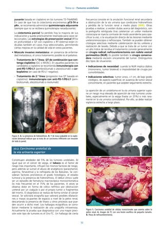 Tema 10 · Tumores uroteliales
53
yuvante basada en cisplatino en los tumores T2-T4aN0M0.
En caso de que tras la cistectomía encontremos pT3-T4 o
pN+, se recomienda administrar quimioterapia adyuvante
(siempre que no se recibiera quimioterapia neoadyuvante).
La cistectomía parcial ha perdido hoy la mayoría de sus
indicaciones y queda prácticamente reservada para casos se-
leccionados. Las estrategias de preservación vesical (RTUv
en profundidad + QT con cisplatino + RT externa) están in-
dicadas también en casos muy seleccionados, permitiendo
ciertas mejoras en la calidad de vida en estos pacientes.
• Músculo invasivo metastásico: en presencia de enferme-
dad metastásica, el único tratamiento posible es el paliativo.
- Tratamiento de 1.ª línea: QT de combinación que con-
tenga cisplatino (GC o MVAC). En aquellos pacientes no
candidatos a cisplatino se recomienda inmunoterapia con
anti-PD-1/PD-L1 (pembrolizumab o atezolizumab) o car-
boplatino (en caso de PD-L1 negativo).
- Tratamiento de 2.ª línea (progresión tras QT basada en
cisplatino): inmunoterapia con anti-PD-1/PD-L1 (pem-
brolizumab, atezolizumab o nivolumab).
10.2. Carcinoma urotelial de
la vía urinaria superior
Constituyen alrededor del 5% de los tumores uroteliales. Al
igual que en el cáncer de vejiga, el tabaco es el factor de
riesgo más importante; influyen los mismos factores de riesgo,
pero además se suman el abuso de analgésicos (paracetamol,
aspirina, fenacetina) y la nefropatía de los Balcanes. Se con-
sideran factores pronósticos el grado histológico, el estadio
tumoral y la presencia de hidronefrosis. El debut clínico suele
ser un episodio de hematuria macroscópica monosintomática
(lo más frecuente) en el 75% de los pacientes. A veces se
observa dolor en forma de cólico nefrítico por obstrucción
ureteral por un coágulo o por el propio tumor o fragmentos
del mismo. El diagnóstico se realiza de forma similar al cáncer
vesical. Se solicitará ecografía que valorará posibles dilatacio-
nes o masas ocupantes de espacio a nivel de la pelvis renal,
descartando la presencia de litiasis u otros procesos que pue-
den ocurrir a dicho nivel. Los hallazgos ecográficos se corro-
boran mediante la realización de una urografía intravenosa.
Actualmente la prueba que diagnostica con una mayor preci-
sión este tipo de tumores es el Uro-TC. Un hallazgo de cierta
frecuencia consiste en la anulación funcional renal secundaria
a obstrucción de la vía urinaria que condiciona hidronefrosis
y pérdida de la función renal a medio plazo (MIR). Otras
pruebas a realizar, si existen dudas acerca del diagnóstico, son
la pielografía retrógrada (tras cateterizar un uréter mediante
cistoscopia se inyecta contraste de modo ascendente para opa-
cificar la vía), o la visualización directa de las lesiones mediante
ureterorrenoscopia o nefroscopia. También se pueden obtener
citologías selectivas mediante cateterización de los uréteres y
realización de lavado. Debido a que se trata de un tumor con
un alto índice de recidiva el tratamiento consiste generalmente
en cirugía radical: nefroureterectomía con rodete vesical
perimeático (NUR). Es posible también la cirugía conserva-
dora mediante escisión únicamente del tumor. Distinguimos
dos tipos de situaciones:
• Indicaciones de necesidad: cuando la NUR implica diálisis
(monorreno, tumor bilateral) o imposibilidad de cirugía por
comorbilidades.
• Indicaciones selectivas: tumor único, <1 cm, de bajo grado
citológico, de aspecto superficial, en ausencia de tumor vesical
concomitante, en pacientes que acepten seguimiento estrecho.
La aparición de un urotelioma en la vía urinaria superior supo-
ne un riesgo muy elevado de aparición de más tumores urote-
liales, especialmente en la vejiga (hasta un 25%) o más rara-
mente en la vía urinaria contralateral. Por ello, se debe realizar
vigilancia estrecha a largo plazo.
Figura 4. A. La presencia de hidronefrosis. B. Y de masa palpable en la explo-
ración bimanual indican que se trata de un carcinoma infiltrante con invasión
de toda la pared.
A B
Figura 5. Carcinoma urotelial de células transicionales que asienta sobre la
pelvis renal. A. Imagen de TC con una lesión exofítica de pequeño tamaño.
B. Pieza de nefroureterectomía.
A
B
 