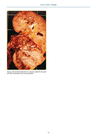 Manual AMIR · Urología
54
Figura 6. Pieza de nefroureterectomía con carcinoma urotelial de alto grado
que infiltra el parénquima renal y la grasa peripiélica.
 