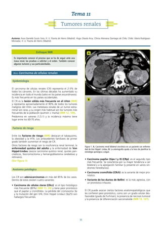 55
11.1. Carcinoma de células renales
Epidemiología
El carcinoma de células renales (CR) representa el 2-3% de
todos los cánceres. En las últimas décadas ha aumentado su
incidencia en todo el mundo (salvo en los países escandinavos).
Es más frecuente en los países occidentales.
El CR es la lesión sólida más frecuente en el riñón (MIR)
y representa aproximadamente el 90% de todos los tumores
malignos del riñón. Las metástasis renales de un tumor extra-
rrenal son raras, y su origen más habitual son los tumores más
frecuentes de la población (pulmón > mama) (MIR 12, 109).
Predomina en varones (1,5:1) y la incidencia máxima tiene
lugar entre los 60-70 años.
Factores de riesgo
Entre los factores de riesgo (MIR) destacan el tabaquismo,
la obesidad y la HTA. Los antecedentes familiares de primer
grado también aumentan el riesgo de CR.
Otros factores de riesgo son la insuficiencia renal terminal, la
enfermedad quística del adulto y la enfermedad de Von
Hippel-Lindau (asocia carcinoma quístico renal, quistes pan-
creáticos, feocromocitoma y hemangioblastoma cerebeloso y
retiniano).
(Ver figura 1)
Anatomía patológica
Los CR son adenocarcinomas en más del 85% de los casos.
Dentro de estos existen cuatro variantes:
• Carcinoma de células claras (CRcc): es el tipo histológico
más frecuente (80%) (MIR 11, 24) y tiene peor pronóstico
que el papilar y cromófobo. La pérdida del cromosoma 3p
y la mutación del gen VHL (Von Hippel Lindau) (3p25) son
hallazgos frecuentes.
• Carcinoma papilar (tipo I y II) (CRp): es el segundo tipo
más frecuente. Se caracteriza por su mayor tendencia a ser
bilateral y a la agregación familiar (y presente en varios sín-
dromes hereditarios).
• Carcinoma cromófobo (CRch): es la variante de mejor pro-
nóstico.
• Variante de los ductos de Bellini: es la más agresiva, con
un pronóstico infausto.
El CR puede asociar ciertos factores anatomopatológicos que
les confieren peor pronóstico, como son un grado celular des-
favorable (grado de Furhman), la presencia de necrosis tumoral
y la presencia de diferenciación sarcomatoide (MIR 13, 127).
Figura 1. A. Carcinoma renal bilateral sincrónico en un paciente con enferme-
dad de Von Hippel- Lindau. B. La arteriografía ayuda a la hora de planificar la
estrategia quirúrgica a seguir.
A
B
Tumores renales
Tema 11
Autores: Aura Daniella Souto Soto, H. U. Puerta de Hierro (Madrid). Hugo Otaola Arca, Clínica Alemana (Santiago de Chile, Chile). María Rodríguez-
Monsalve, H. U. Puerta de Hierro (Madrid).
Enfoque MIR
Es importante conocer el proceso que se ha de seguir ante una
masa renal, las pruebas a solicitar y el orden. También conocer
algunos tumores y sus particularidades.
 