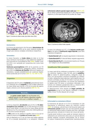 Manual AMIR · Urología
56
Clínica
Asintomático
Es la forma de presentación más frecuente, detectándose de
forma incidental (>50% de los casos) mediante pruebas de
imagen para diversos complejos sintomáticos inespecíficos.
Sintomático
Es menos frecuente. La tríada clásica de dolor en la fosa
renal, hematuria macroscópica y masa abdominal palpable es
poco frecuente en la actualidad (6-10%) (MIR). Pueden cursar
con HTA o con varicocele por compromiso de la vena renal
izquierda.
Síndromes paraneoplásicos (30% de los pacientes con CR
sintomático). Hipercalcemia, poliglobulia, anemia, incremento
de la VSG o el síndrome de Stauffer (disfunción hepática no
metastásica, causada probablemente por sustancias hepato-
tóxicas producidas por el tumor) (MIR 14, 132; MIR 10, 99).
Diagnóstico
El diagnóstico del CR suele ser incidental, generalmente duran-
te la realización de una ecografía. En ella se deben diferenciar
las masas sólidas (que orientan a CR) de los quistes (de aspecto
regular, anecoico y con refuerzo posterior) (MIR 18, 15).
La técnica diagnóstica de elección para el CR es la TC abdo-
minopélvica con contraste, que no sólo distingue los quistes
de las masas sólidas, sino que entre las masas sólidas permite
diferenciar los CR y oncocitomas (estos dos indistinguibles por
TC) de otros tumores benignos.
La RM puede ser de utilidad en aquellos casos en los que se
sospeche presencia de trombo en la vena cava (MIR).
Ante el diagnóstico en TC de una masa renal sólida sugerente
de CR se procede directamente a su extirpación mediante
nefrectomía radical o parcial, según cada caso (MIR 11, 23).
No se realizan previamente biopsias por el alto riesgo de falsos
negativos y la alta especificidad de las pruebas de imagen.
En base a los hallazgos en la TC, a las lesiones renales quís-
ticas se les aplica la clasificación según Bosniak, pues tiene
importancia terapéutica
• Quiste Bosniak I y II: no requiere seguimiento ni intervención.
• Quiste Bosniak IIF (la F viene de Follow): requieren seguimiento.
• Quiste Bosniak III y IV: se recomienda tratarlos con CR pues
son malignos con alta probabilidad.
Estadificación TNM y pronóstico
La mayor parte de las metástasis se presentan a nivel ganglio-
nar, pulmonar, hepático y óseo. Por ello, para la estadifica-
ción se realiza TC abdomino-pélvica, radiografía simple de
tórax, y en caso de dolor o síntomas compatibles con metásta-
sis óseas, radiografías óseas selectivas o gammagrafía ósea. Los
tumores confinados al riñón (T1-T2) tienen muy buen pronós-
tico (supervivencia del 80-90%). Los tumores que sobrepasan
la cápsula renal (T3) tienen un pronóstico intermedio, y los
tumores con metástasis ganglionares (N1) o a distancia (M1)
un peor pronóstico (supervivencia del 10-20%).
El adenocarcinoma renal requiere de largos periodos de
seguimiento ya que se han descrito metástasis o recidivas
tardías incluso 10 años después de la cirugía.
Tratamiento
Enfermedad no metastásica (CRnm)
El tratamiento de elección en el CR no metastásico ha sido
clásicamente la nefrectomía radical con intención curativa
(MIR). Sin embargo, a día de hoy es más frecuente realizar una
nefrectomía parcial siempre que sea técnicamente posible.
La nefrectomía radical implica la exéresis del riñón y del tejido
graso perirrenal, incluido en el interior de la fascia de Gerota.
Cuando existe trombo en cava, puede ser necesario realizar la
nefrectomía con control de la vena cava y la aurícula derecha
asistida mediante circulación extracorpórea. No es necesa-
rio realizar linfadenectomía retroperitoneal sistemáticamente,
Recuerda...
Los quistes renales simples son muy frecuentes en la
población general y tan sólo requieren seguimiento ecográfico
periódico (MIR), a menos que se compliquen (sangrado…).
Figura 3. Carcinoma de células renales izquierdo.
Figura 2. Carcinoma de células renales, tipo células claras (CRcc).
 
