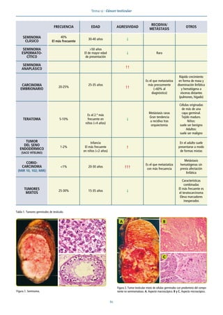 Tema 12 · Cáncer testicular
61
Figura 2. Tumor testicular mixto de células germinales con predominio del compo-
nente no seminomatoso. A. Aspecto macroscópico. B y C. Aspecto microscópico.
A B
C
Figura 1. Seminoma.
FRECUENCIA EDAD AGRESIVIDAD
RECIDIVA/
METÁSTASIS
OTROS
SEMINOMA
CLÁSICO
40%
El más frecuente
30-40 años ↓
SEMINOMA
ESPERMATO-
CÍTICO
>50 años
El de mayor edad
de presentación
↓ Rara
SEMINOMA
ANAPLÁSICO
↑↑
CARCINOMA
EMBRIONARIO
20-25%
25-35 años
↑↑
Es el que metastatiza
más precozmente
(>60% al
diagnóstico)
Rápido crecimiento
en forma de masa y
diseminación linfática
y hematógena a
vísceras distantes
(pulmones, hígado)
TERATOMA 5-10%
Es el 2.º más
frecuente en
niños (<4 años)
↓
Metástasis raras
Gran tendencia
a recidiva tras
orquiectomía
Células originadas
de más de una
capa germinal.
Tejido maduro.
Niños:
suele ser benigno
Adultos:
suele ser maligno
TUMOR
DEL SENO
ENDODÉRMICO
(SACO VITELINO)
1-2%
Infancia
El más frecuente
en niños (<2 años)
↑
En el adulto suele
presentarse a modo
de formas mixtas
CORIO-
CARCINOMA
(MIR 10, 102; MIR)
<1% 20-30 años ↑↑↑
Es el que metastatiza
con más frecuencia
Metástasis
hematógenas sin
previa afectación
linfática
TUMORES
MIXTOS
25-30% 15-35 años ↓
Características
combinadas
El más frecuente es
el teratocarcinoma
Eleva marcadores
inesperados
Tabla 1. Tumores germinales de testículo.
 