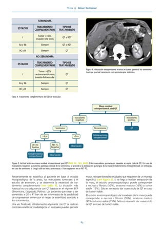Tema 12 · Cáncer testicular
63
Posteriormente se estadifica al paciente en base al estudio
histopatológico de la pieza, los marcadores tumorales y el
estudio de extensión, y se determina la necesidad de tra-
tamiento complementario (ver tabla 4). La situación más
habitual es una adyuvancia con QT basada en el régimen BEP
(Bleomicina, Etopósido, Platino). Los pacientes que vayan a ser
sometidos a QT o RT han de ser informados de la posibilidad
de criopreservar semen por el riesgo de esterilidad asociado a
los tratamientos.
Una vez finalizado el tratamiento adyuvante con QT se realizan
controles analíticos y radiológicos en los cuales pueden persistir
masas retroperitoneales residuales que requieren de un manejo
específico (ver figura 5). Si se llega a realizar extirpación de
la masa, el estudio anatomopatológico puede corresponder
a necrosis / fibrosis (50%), teratoma maduro (35%) o tumor
viable (15%). Sólo es necesario dar nuevo ciclo de QT en caso
de tumor viable.
El estudio anatomopatológico de la exéresis de la masa puede
corresponder a necrosis / fibrosis (50%), teratoma maduro
(35%) o tumor viable (15%). Sólo es necesario dar nuevo ciclo
de QT en caso de tumor viable.
Figura 4. Afectación retroperitoneal masiva en tumor germinal no seminoma-
toso que precisa tratamiento con quimioterapia sistémica.
Figura 5. Actitud ante una masa residual retroperitoneal post QT (MIR 18, 185; MIR). Si los marcadores permanecen elevados se repite ciclo de QT. En caso de
marcadores negativos y anatomía patológica inicial de no seminoma, se procede a la extirpación quirúrgica de la masa (linfadenectomía retroperitoneal); sin embargo,
en caso de seminoma la cirugía sólo se indica ante masas >3 cm captantes en un PET-TC.
Marcadores
negativos
Marcadores
positivos
PET-TC
Positivo
PET-TC
Negativo
Linfadenectomía
retroperitoneal
Linfadenectomía
retroperitoneal
No seminoma
Observación
Observación
>3cm <3cm
QT
Seminoma
Masa residual
retroperitoneal post QT
SEMINOMA
ESTADIO
TRATAMIENTO
COMPLEMENTARIO
TIPO DE
TRATAMIENTO
I
Tumor >4 cm,
invasión rete testis
QT o RDT
IIa y IIb Siempre QT o RDT
IIC y III Siempre QT
NO SEMINOMA
ESTADIO
TRATAMIENTO
COMPLEMENTARIO
TIPO DE
TRATAMIENTO
I
Tumor >50%
carcinoma embrionario,
invasión linfovascular
QT
IIa y IIb Siempre QT
IIC y III Siempre QT
Tabla 4. Tratamiento complementario del cáncer testicular.
 