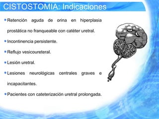 CISTOSTOMIA: Indicaciones
Retención aguda de orina en hiperplasia

prostática no franqueable con catéter uretral.

Incontinencia persistente.

Reflujo vesicoureteral.

Lesión uretral.

Lesiones   neurológicas      centrales   graves   e

incapacitantes.

Pacientes con cateterización uretral prolongada.
 