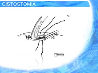 CISTOSTOMIA
 