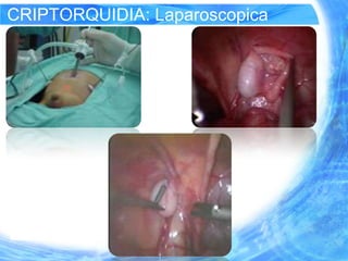 CRIPTORQUIDIA: Laparoscopica
 