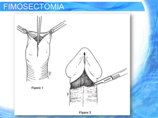 FIMOSECTOMIA
 