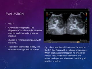 Urological Complications in Renal Transplant 2.pptx