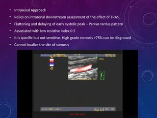 Urological Complications in Renal Transplant 2.pptx