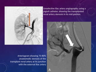 Urological Complications in Renal Transplant 2.pptx