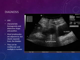 Urological Complications in Renal Transplant 2.pptx