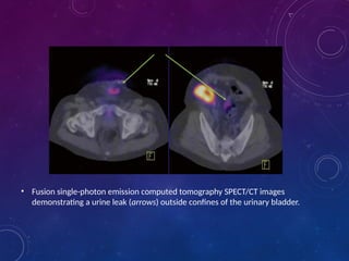Urological Complications in Renal Transplant 2.pptx