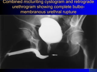 Retrograde Urethrogram Rupture Urological emergencies | PPT