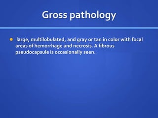 Gross pathology
 large, multilobulated, and gray or tan in color with focal
areas of hemorrhage and necrosis. A fibrous
pseudocapsule is occasionally seen.
 