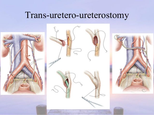 Urological Trauma During O G Procedures