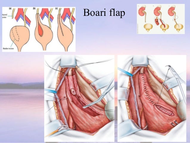 suture absorbable o during procedures Urological trauma O/G