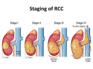 Staging of RCC
 