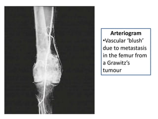 Arteriogram
•Vascular ‘blush’
due to metastasis
in the femur from
a Grawitz’s
tumour
 