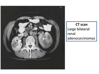 CT scan
Large bilateral
renal
adenocarcinomas
 