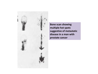 Bone scan showing
multiple hot spots
suggestive of metastatic
disease in a man with
prostate cancer
 