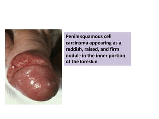 Penile squamous cell
carcinoma appearing as a
reddish, raised, and firm
nodule in the inner portion
of the foreskin
 
