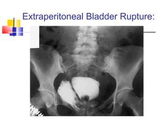 Urologic trauma | PPT