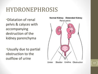 HYDRONEPHROSIS
•Dilatation of renal
pelvis & calyces with
accompanying
destruction of the
kidney parenchyma
•Usually due to partial
obstruction to the
outflow of urine
17
 