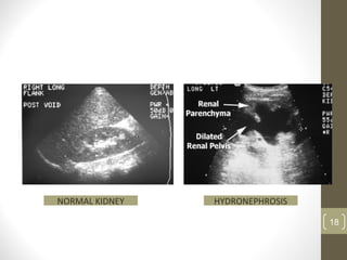 18
NORMAL KIDNEY HYDRONEPHROSIS
 