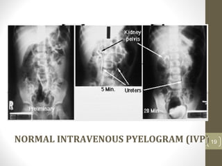 NORMAL INTRAVENOUS PYELOGRAM (IVP)19
 