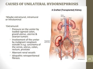 CAUSES OF UNILATERAL HYDORNEPHROSIS
•Maybe extramural, intramural
or Intraluminal
•Extramural:
• Pressure on the ureter by
loaded sigmoid colon,
gravid uterus, uterine &
ovarian tumors
• Involvement of the ureter
by malignant neoplasm
outside it e.g. carcinoma of
the cervix, uterus, colon,
rectum, prostate
• Aberrant renal vessels
• Idiopathic retroperitoneal
fibrosis 25
 