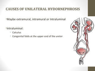 CAUSES OF UNILATERAL HYDORNEPHROSIS
•Maybe extramural, intramural or Intraluminal
•Intraluminal:
• Calculus
• Congenital folds at the upper end of the ureter
27
 