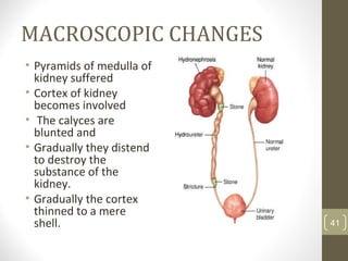 MACROSCOPIC CHANGES
• Pyramids of medulla of
kidney suffered
• Cortex of kidney
becomes involved
• The calyces are
blunted and
• Gradually they distend
to destroy the
substance of the
kidney.
• Gradually the cortex
thinned to a mere
shell. 41
 