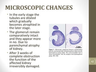 MICROSCOPIC CHANGES
• In the early stage the
tubules are dilated
which gradually
becomes atrophied in
the later stage.
• The glomeruli remain
comparatively intact
and they appear more
in no. Due to
parenchymal atrophy
of kidney.
• After 3 weeks of
complete obstruction
the function of the
affected kidney
irreversibly damaged.
42
 
