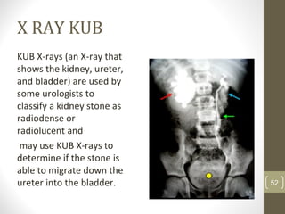 X RAY KUB
KUB X-rays (an X-ray that
shows the kidney, ureter,
and bladder) are used by
some urologists to
classify a kidney stone as
radiodense or
radiolucent and
may use KUB X-rays to
determine if the stone is
able to migrate down the
ureter into the bladder. 52
 