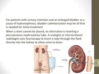 For patients with urinary retention and an enlarged bladder as a
cause of hydronephrosis, bladder catheterization may be all that
is needed for initial treatment.
When a stent cannot be placed, an alternative is inserting a
percutaneous nephrostomy tube. A urologist or interventional
radiologist uses fluoroscopy to insert a tube through the flank
directly into the kidney to allow urine to drain.
61
 