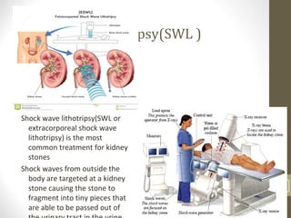 Shock wave lithotripsy(SWL )
Shock wave lithotripsy(SWL or
extracorporeal shock wave
lithotripsy) is the most
common treatment for kidney
stones
Shock waves from outside the
body are targeted at a kidney
stone causing the stone to
fragment into tiny pieces that
are able to be passed out of
62
 