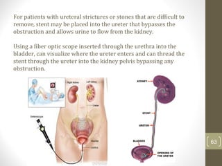 For patients with ureteral strictures or stones that are difficult to
remove, stent may be placed into the ureter that bypasses the
obstruction and allows urine to flow from the kidney.
Using a fiber optic scope inserted through the urethra into the
bladder, can visualize where the ureter enters and can thread the
stent through the ureter into the kidney pelvis bypassing any
obstruction.
63
 