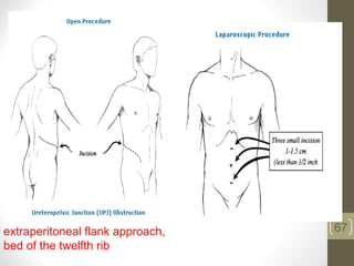 67extraperitoneal flank approach,
bed of the twelfth rib
 