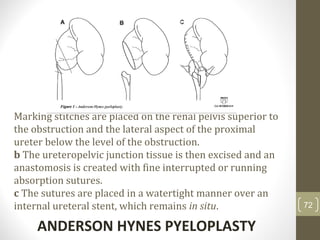 Marking stitches are placed on the renal pelvis superior to 
the obstruction and the lateral aspect of the proximal 
ureter below the level of the obstruction. 
b The ureteropelvic junction tissue is then excised and an 
anastomosis is created with fine interrupted or running 
absorption sutures. 
c The sutures are placed in a watertight manner over an 
internal ureteral stent, which remains in situ.
ANDERSON HYNES PYELOPLASTY
72
 