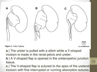 74
a | The ureter is pulled with a stitch while a Y-shaped
incision is made in the renal pelvis and ureter.
b | A V-shaped flap is opened in the ureteropelvic junction
tissue.
c | The V-shaped flap is sutured to the apex of the ureteral
incision with fine interrupted or running absorption sutures.
 