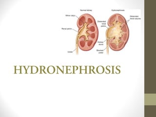 HYDRONEPHROSIS
 