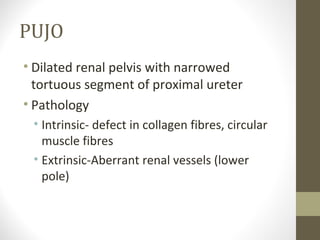 PUJO
• Dilated renal pelvis with narrowed
tortuous segment of proximal ureter
• Pathology
• Intrinsic- defect in collagen fibres, circular
muscle fibres
• Extrinsic-Aberrant renal vessels (lower
pole)

 