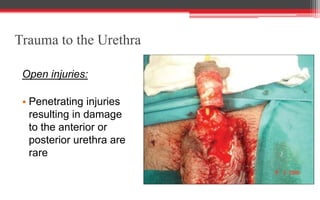Trauma to the Urethra
Open injuries:
• Penetrating injuries
resulting in damage
to the anterior or
posterior urethra are
rare
 