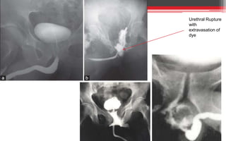 Urethral Rupture
with
extravasation of
dye
 