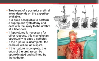 • Treatment of a posterior urethral
injury depends on the expertise
available.
• It is quite acceptable to perform
a suprapubic cystostomy and
deal with the injury to the urethra
at a later date.
• If laparotomy is necessary for
other reasons, this may give an
opportunity to pass a catheter.
• If the rupture is incomplete, the
catheter will act as a splint.
• If the rupture is complete, the
ends of the urethra can be
approximated and splinted by
the catheter.
 