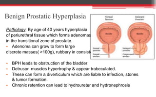Benign Prostatic Hyperplasia
Pathology: By age of 40 years hyperplasia
of periurethral tissue which forms adenomas
in the transitional zone of prostate.
• Adenoma can grow to form large
discrete masses( >100g), rubbery in consistency
• BPH leads to obstruction of the bladder
• Detrusor muscles hypertrophy & appear trabeculated.
• These can form a diverticulum which are liable to infection, stones
& tumor formation.
• Chronic retention can lead to hydroureter and hydronephrosis
 