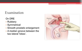 Examination
On DRE
• Rubbery
• Symmetrical
• Smooth prostatic enlargement
• A median groove between the
two lateral ‘lobes’.
 