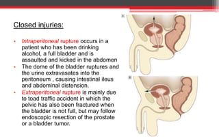 Closed injuries:
• Intraperitoneal rupture occurs in a
patient who has been drinking
alcohol, a full bladder and is
assaulted and kicked in the abdomen
• The dome of the bladder ruptures and
the urine extravasates into the
peritoneum , causing intestinal ileus
and abdominal distension.
• Extraperitoneal rupture is mainly due
to toad traffic accident in which the
pelvic has also been fractured when
the bladder is not full, but may follow
endoscopic resection of the prostate
or a bladder tumor.
 